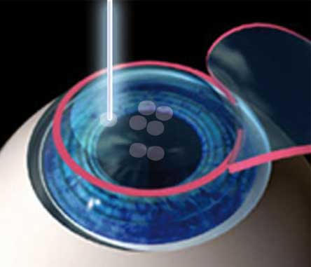 LASIK &  Refractive Laser Surgery Vision Care